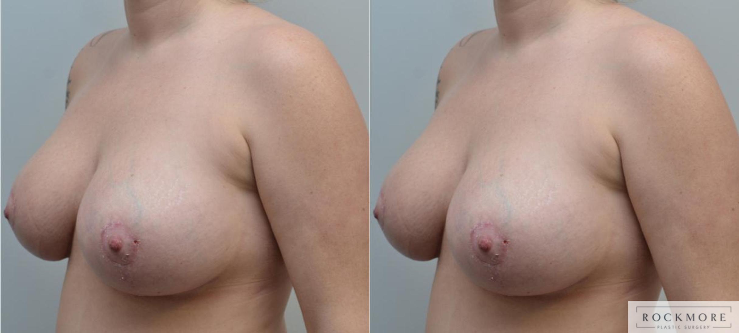 Before & After Breast Lift Case 190 View #2 View in Albany & Latham, New York