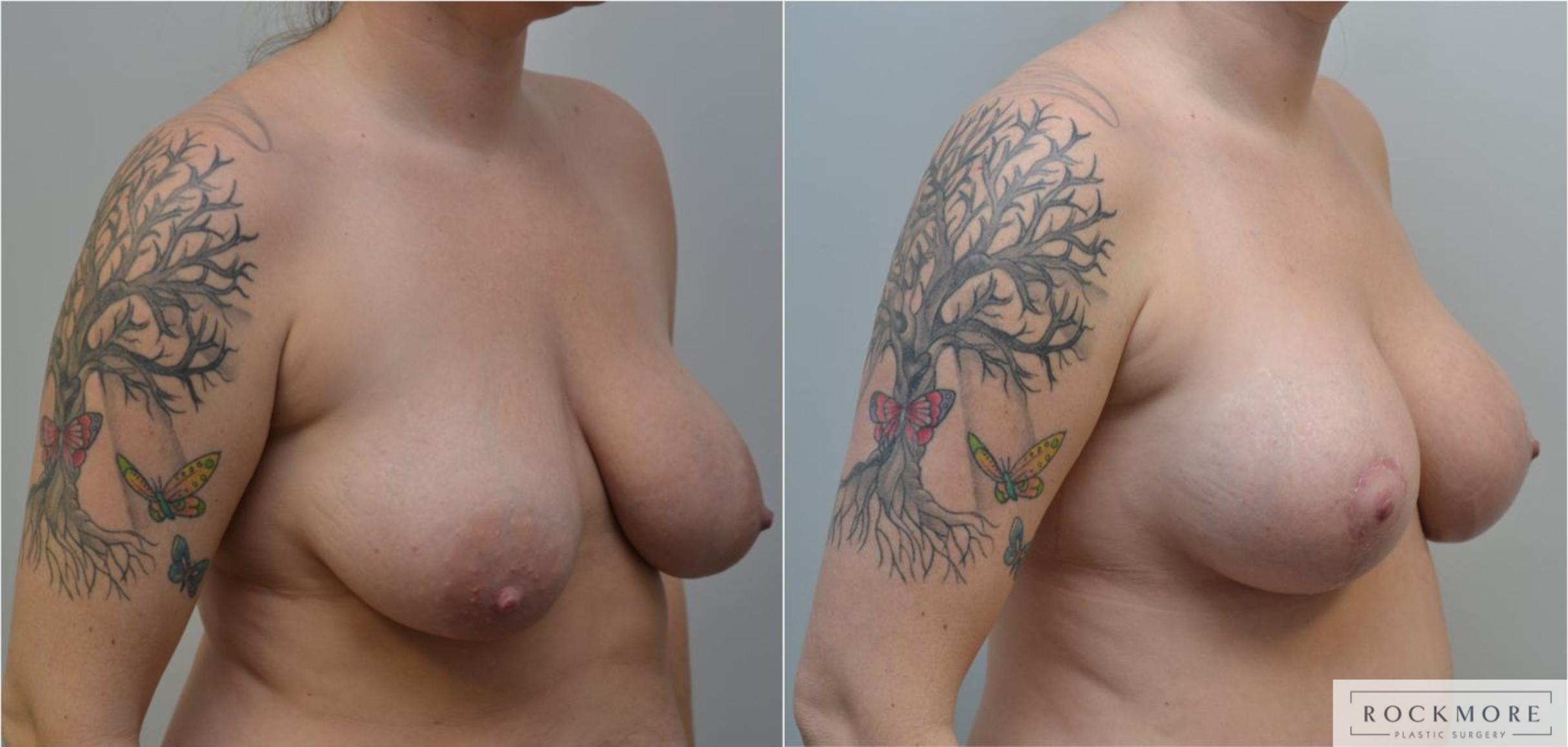 Before & After Breast Lift Case 190 View #3 View in Albany & Latham, New York
