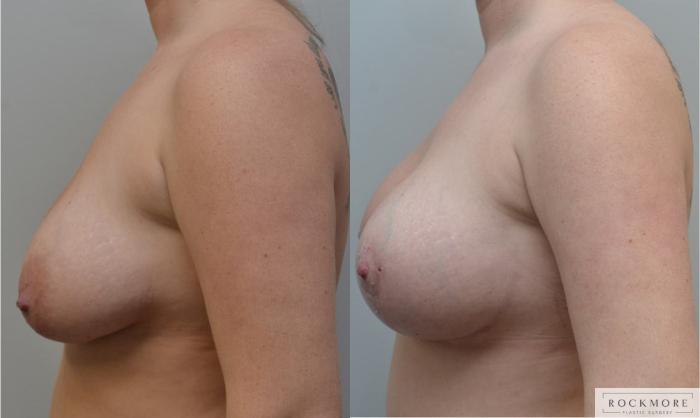Before & After Breast Lift Case 190 View #4 View in Albany & Latham, New York