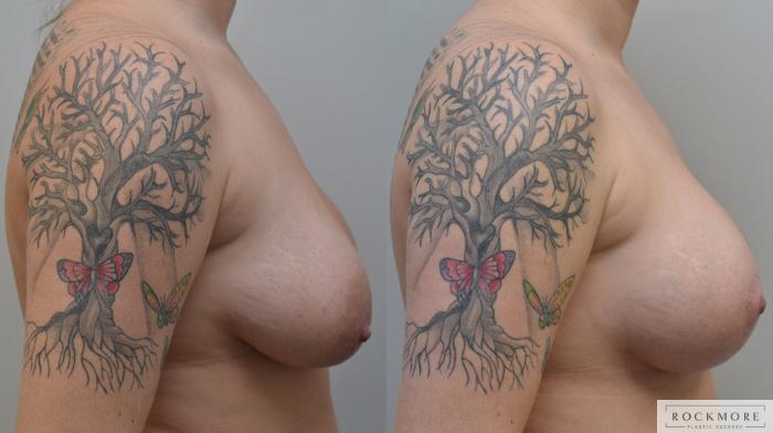 Before & After Breast Lift Case 190 View #5 View in Albany & Latham, New York