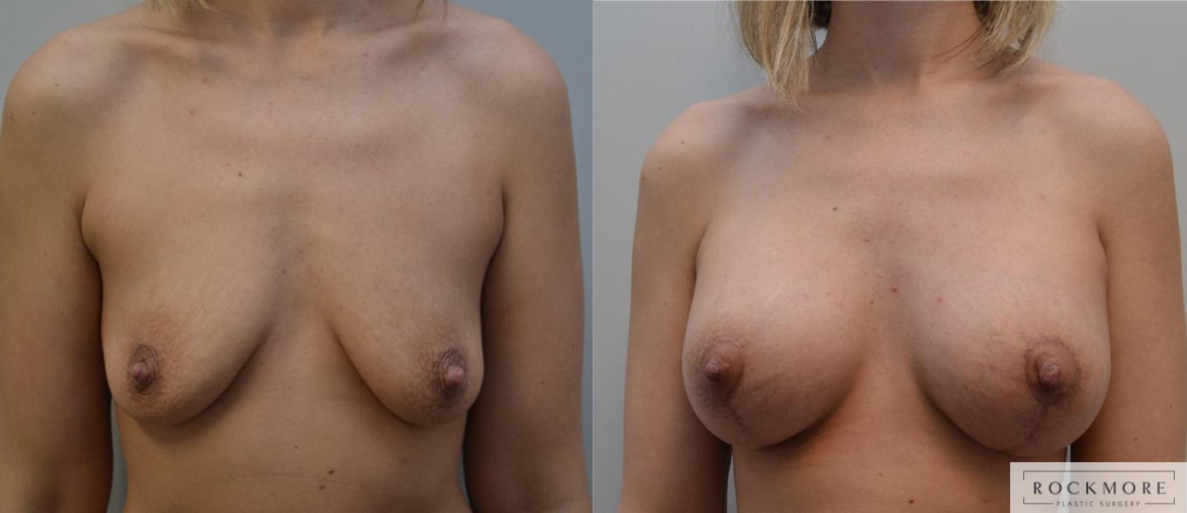 Before & After Breast Lift Case 196 View #1 View in Albany & Latham, New York