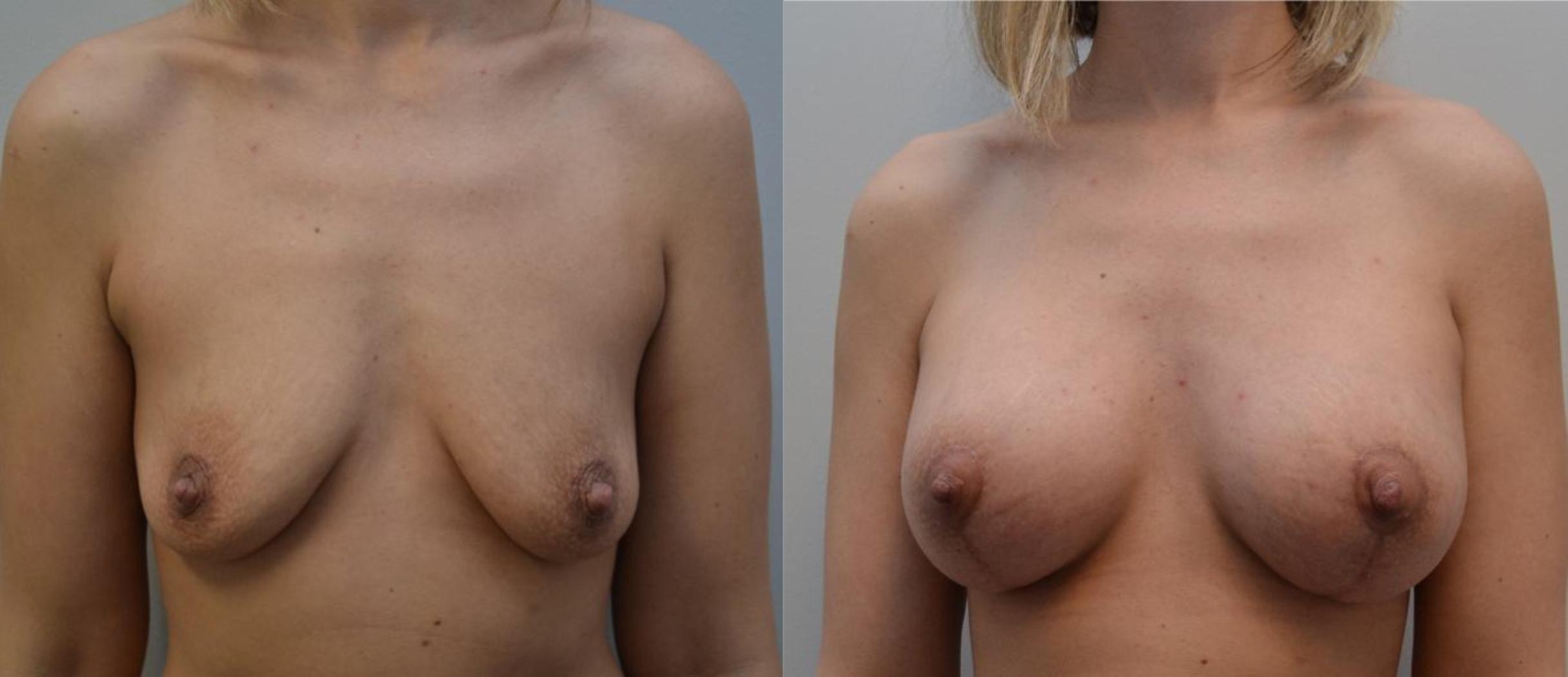 Before & After Breast Lift Case 196 View #1 View in Albany & Latham, New York