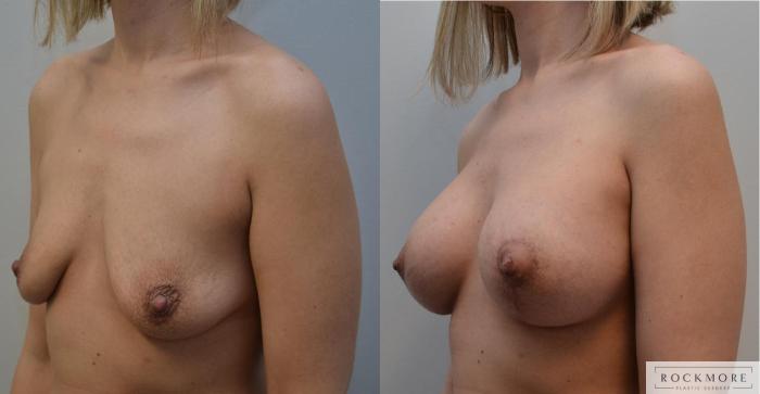 Before & After Breast Lift Case 196 View #2 View in Albany & Latham, New York