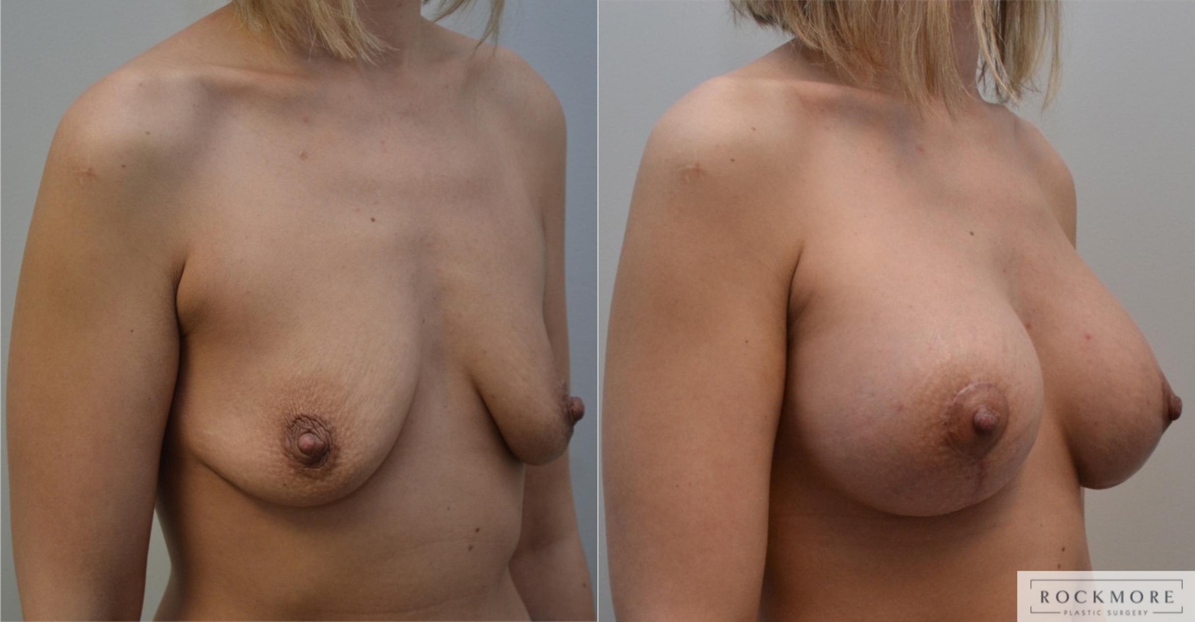 Before & After Breast Lift Case 196 View #3 View in Albany & Latham, New York