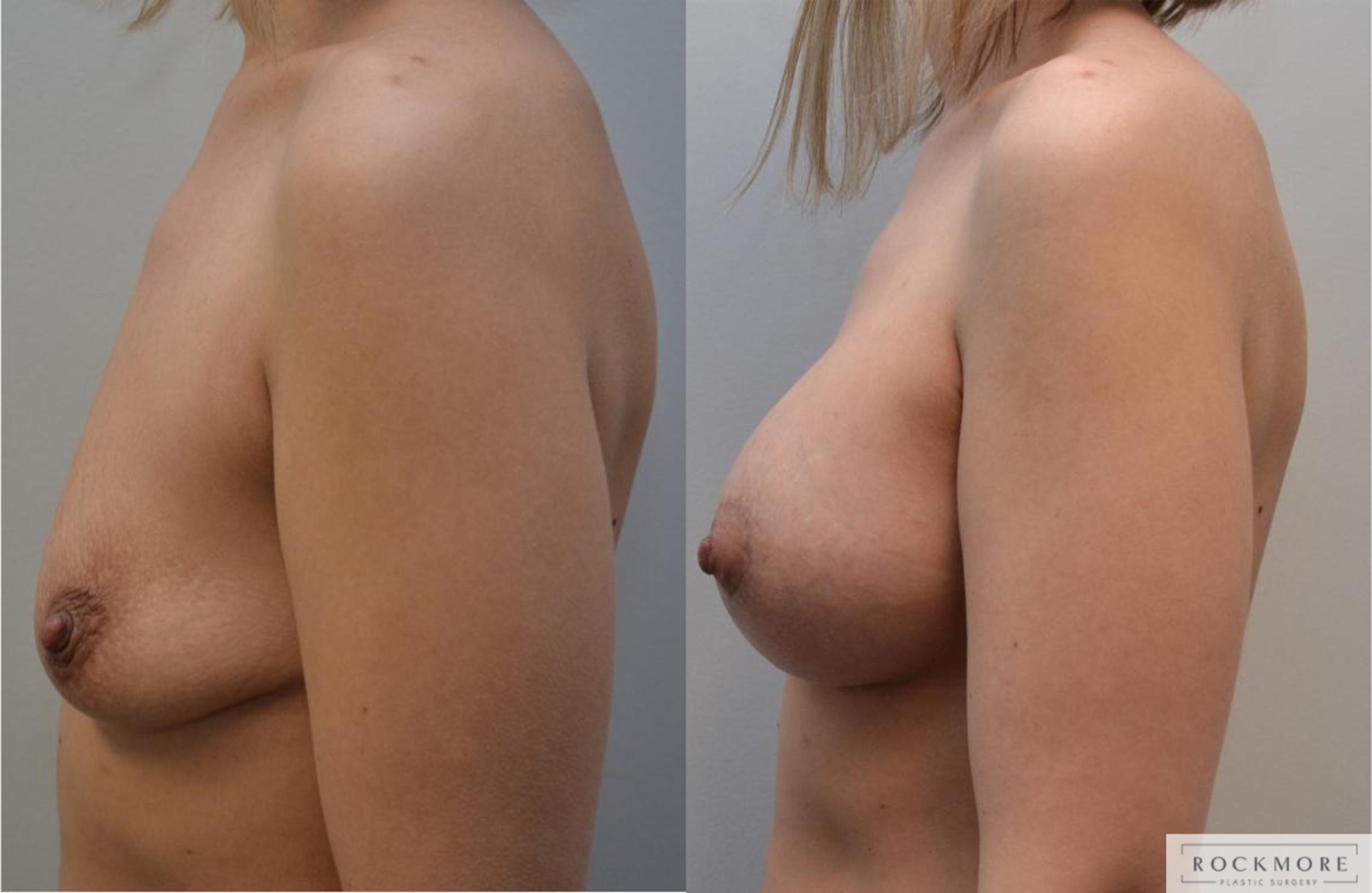 Before & After Breast Lift Case 196 View #4 View in Albany & Latham, New York