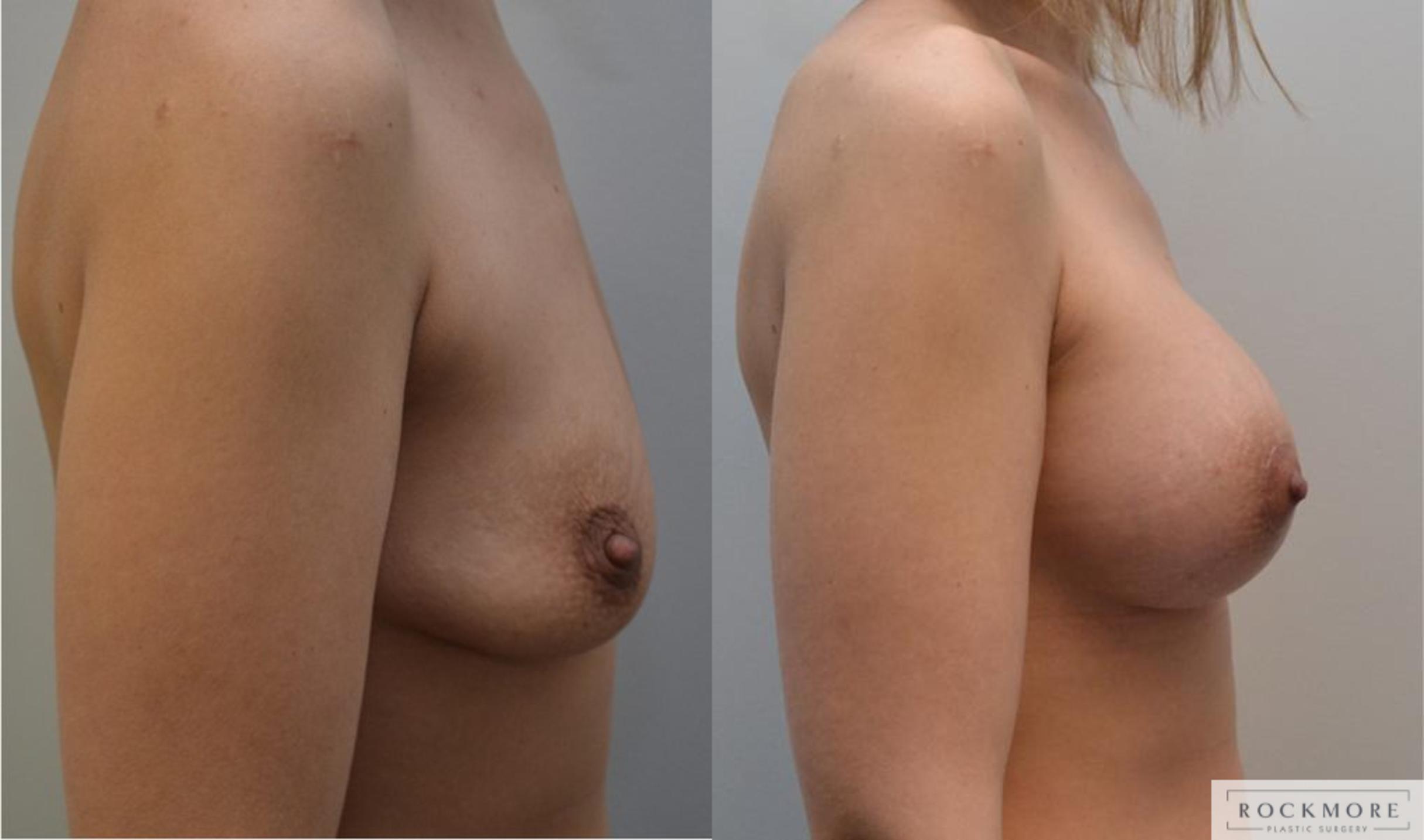 Before & After Breast Lift Case 196 View #5 View in Albany & Latham, New York