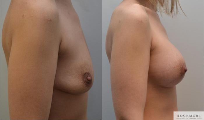 Before & After Breast Lift Case 196 View #5 View in Albany & Latham, New York