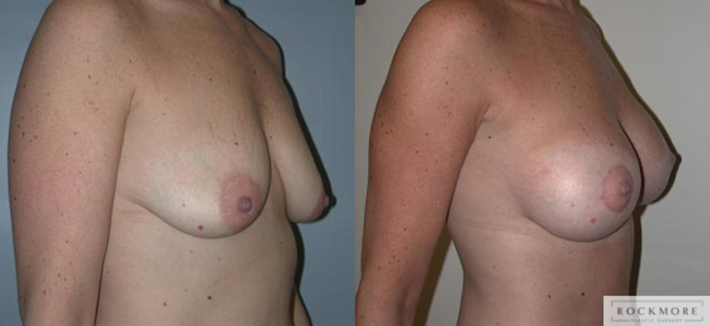 Before & After Breast Lift Case 21 View #1 View in Albany & Latham, New York