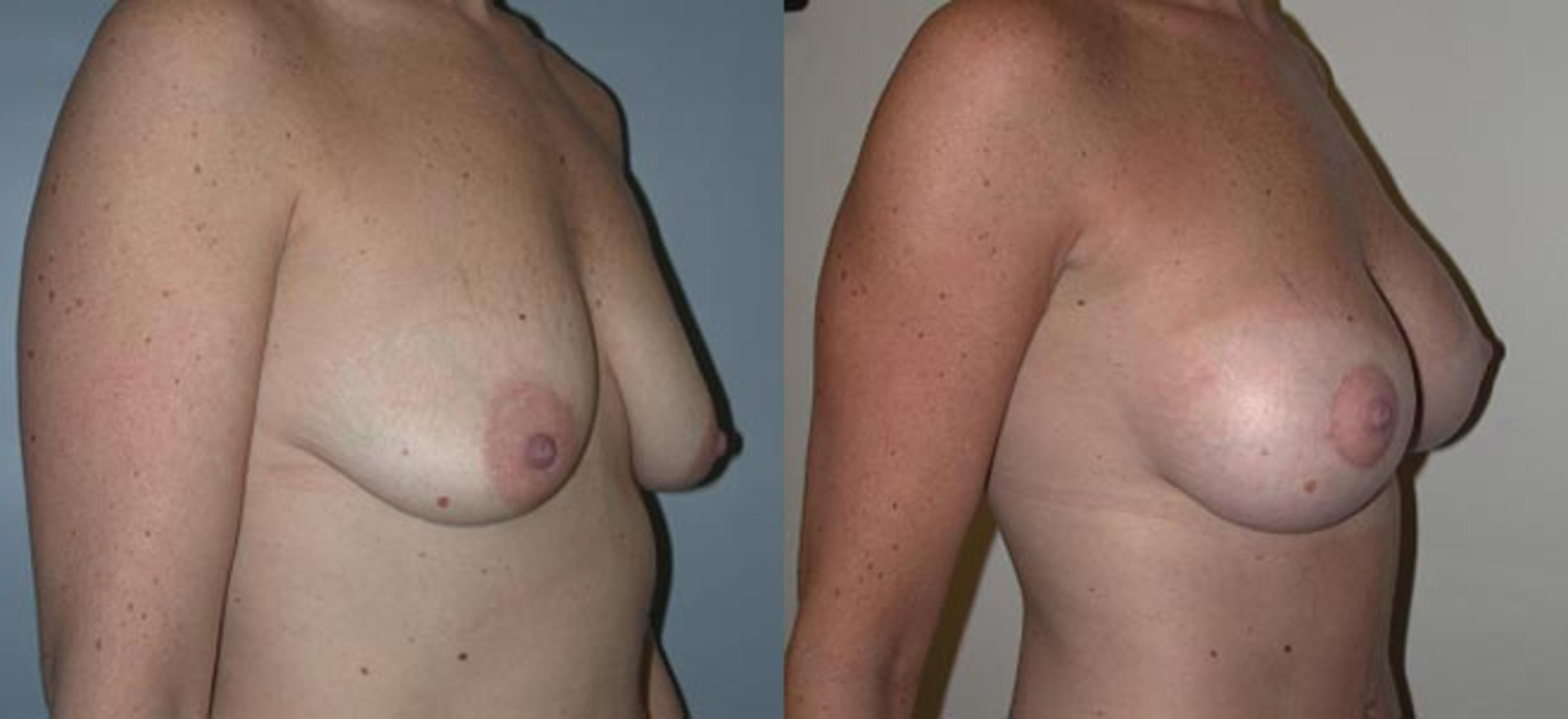 Before & After Breast Lift Case 21 View #1 View in Albany & Latham, New York