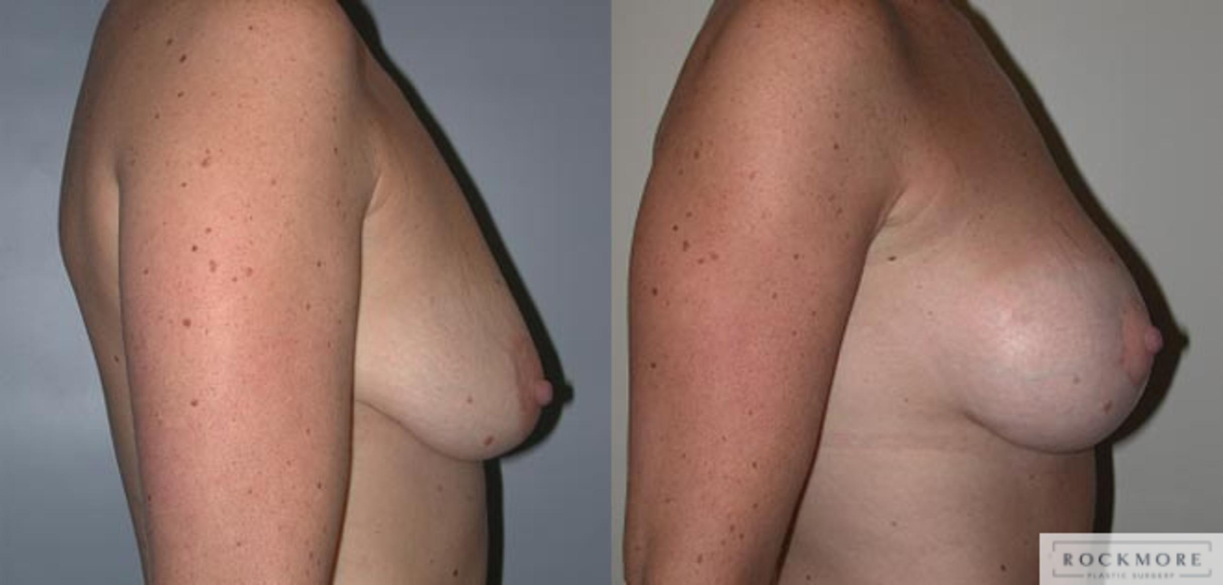 Before & After Breast Lift Case 21 View #2 View in Albany & Latham, New York