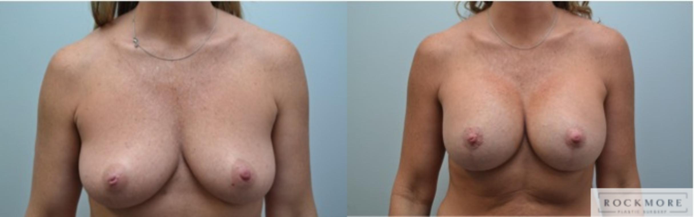 Before & After Breast Lift Case 230 View #1 View in Albany & Latham, New York