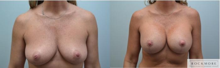 Before & After Breast Lift Case 230 View #1 View in Albany & Latham, New York