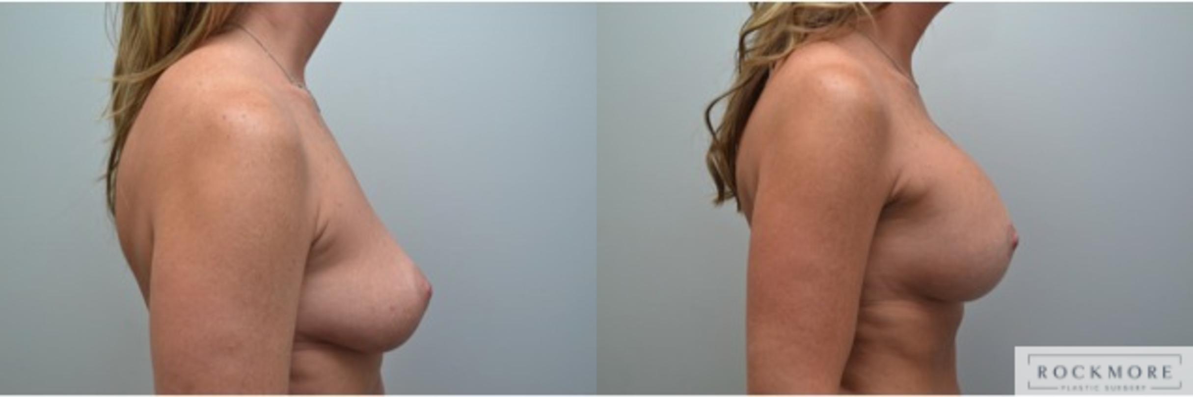 Before & After Breast Lift Case 230 View #2 View in Albany & Latham, New York