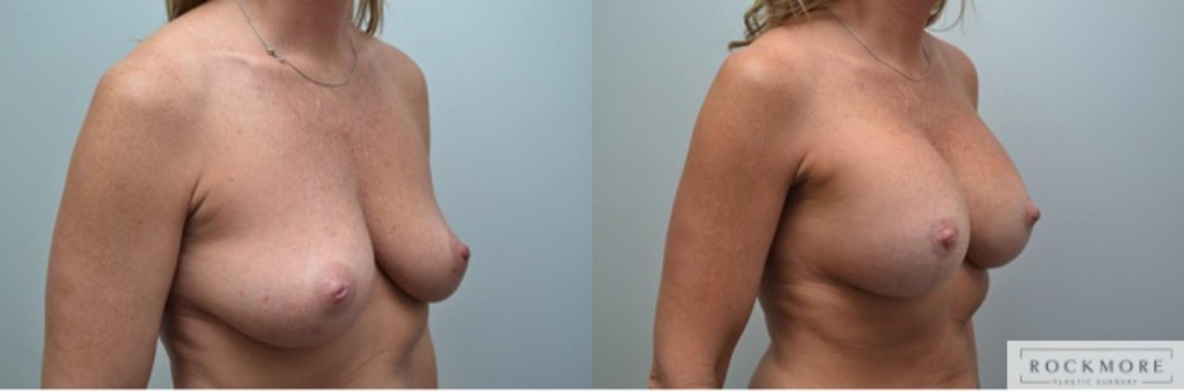 Before & After Breast Lift Case 230 View #3 View in Albany & Latham, New York