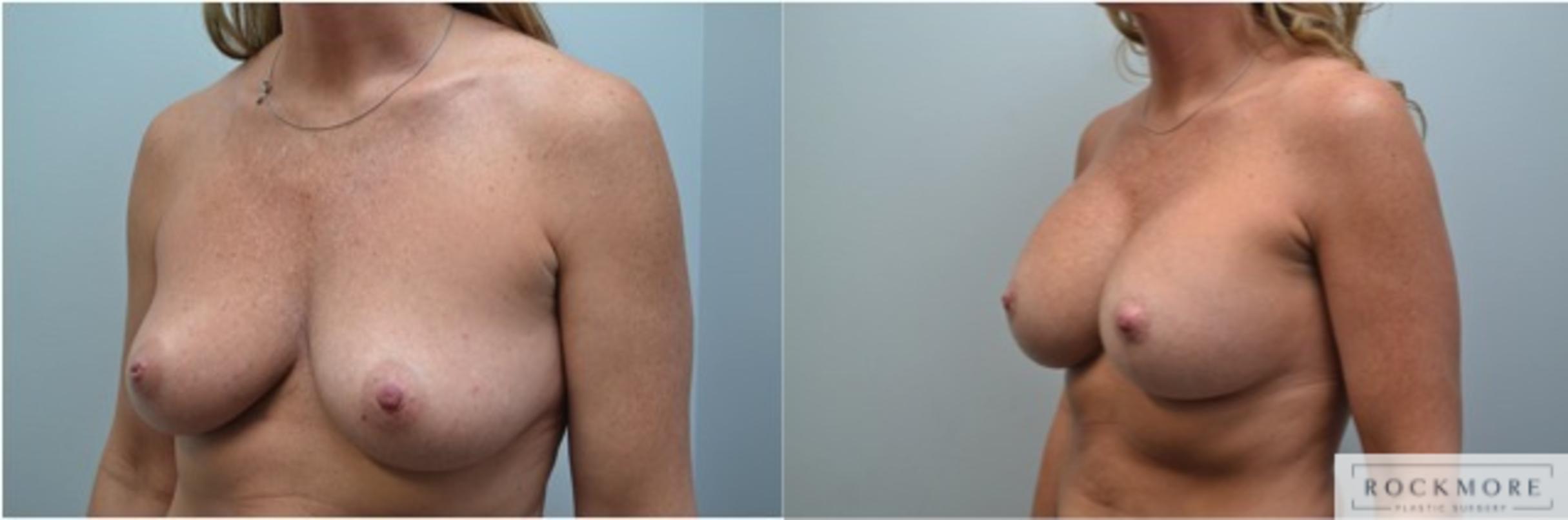 Before & After Breast Lift Case 230 View #4 View in Albany & Latham, New York