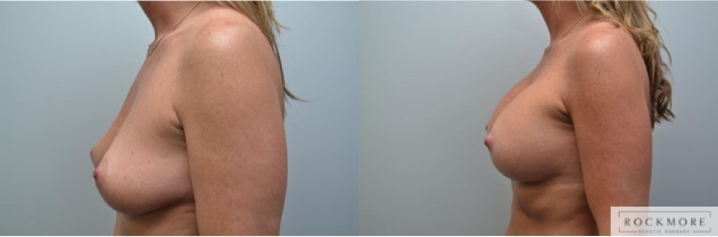 Before & After Breast Lift Case 230 View #5 View in Albany & Latham, New York