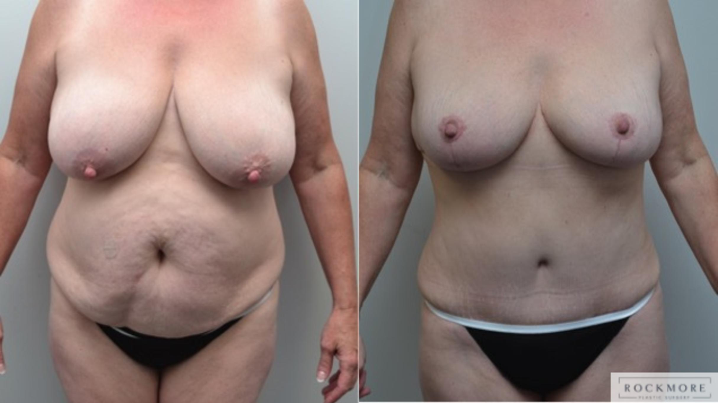 Before & After Breast Lift Case 273 View #1 View in Albany & Latham, New York