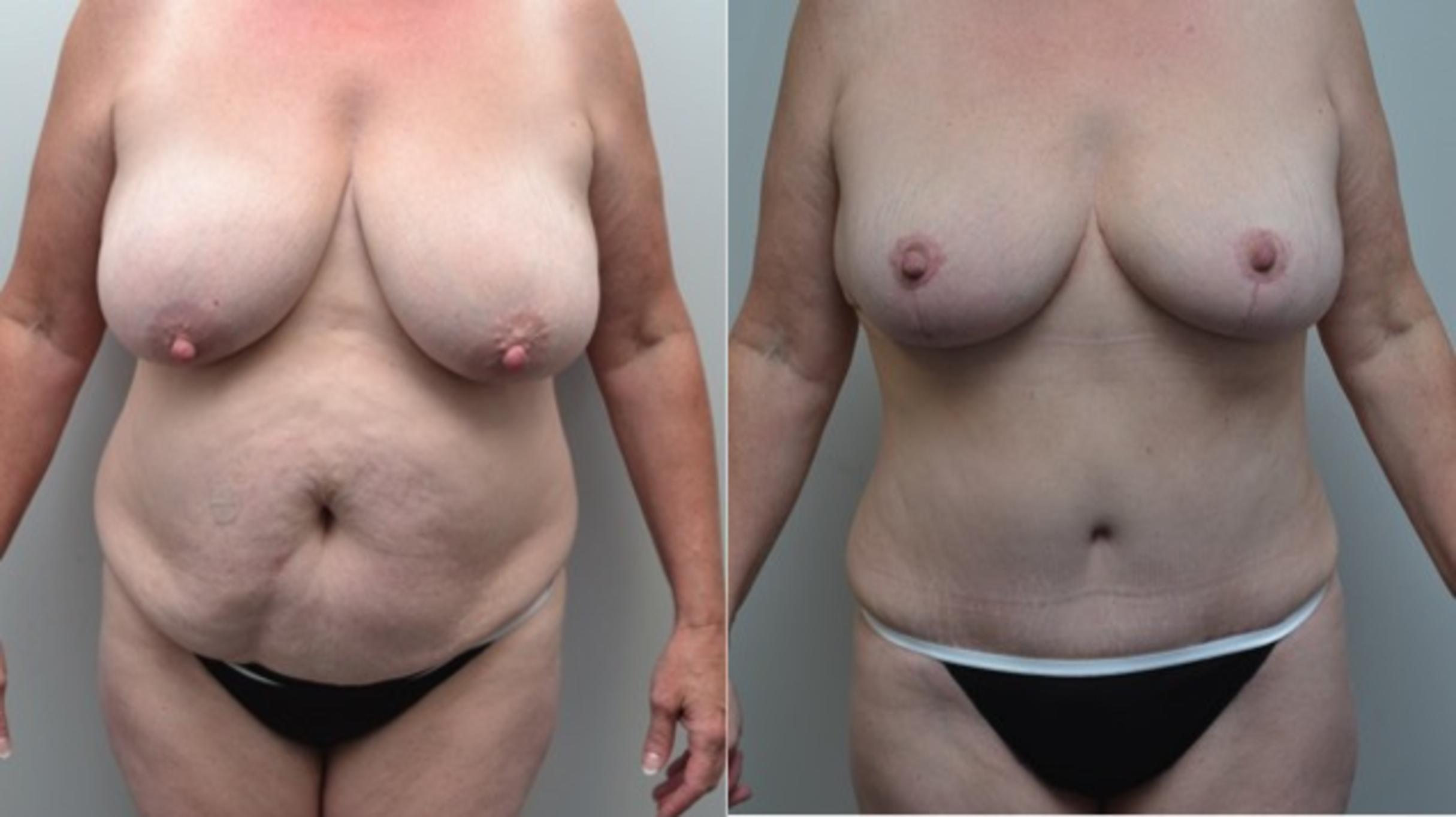 Before & After Breast Lift Case 273 View #1 View in Albany & Latham, New York