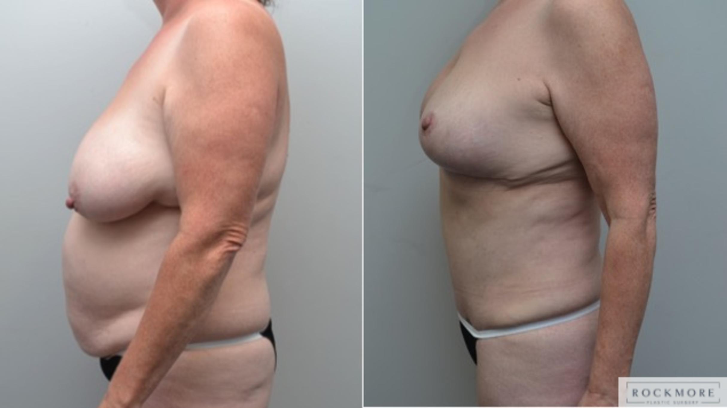Before & After Breast Lift Case 273 View #2 View in Albany & Latham, New York