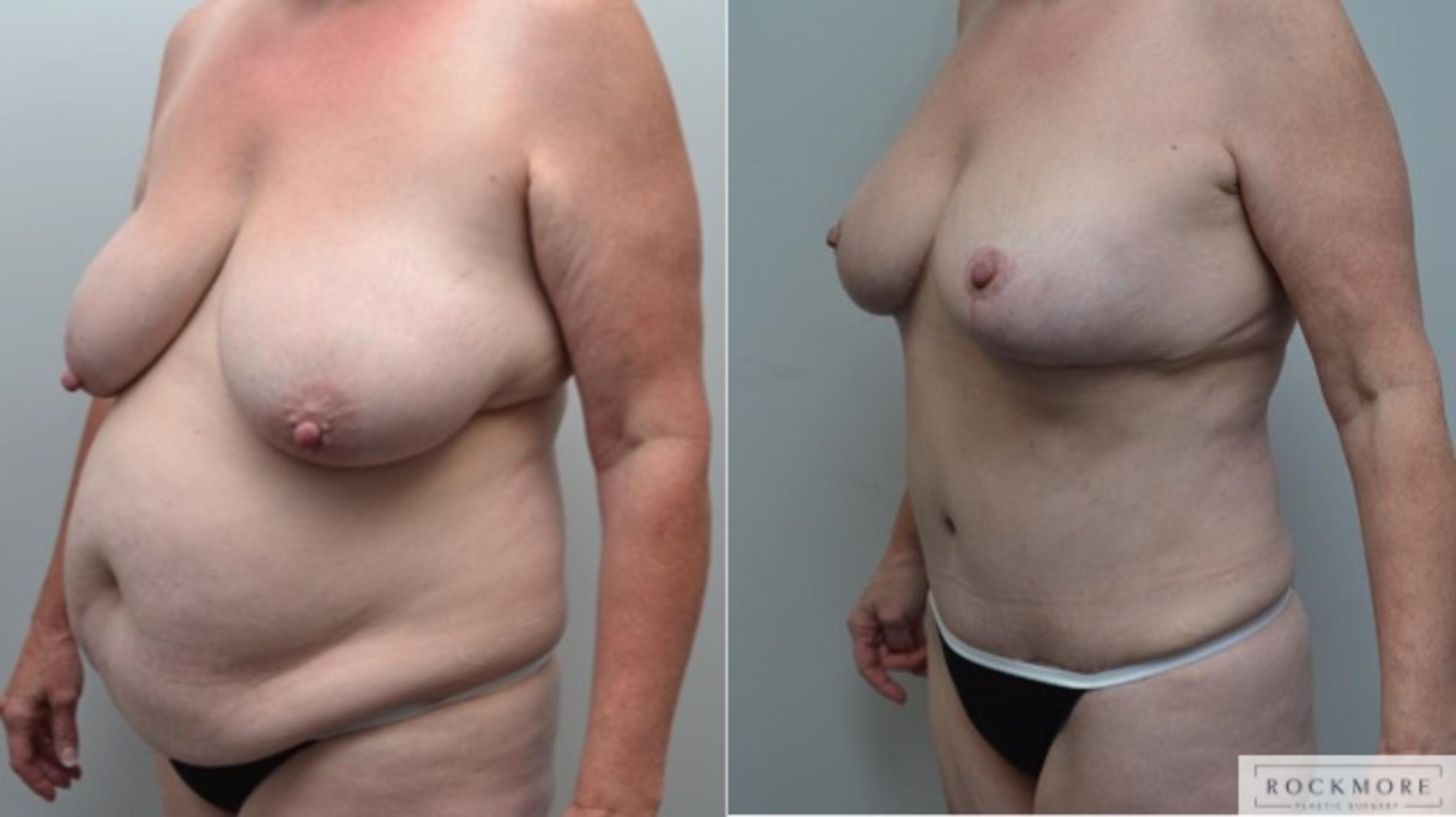 Before & After Breast Lift Case 273 View #3 View in Albany & Latham, New York