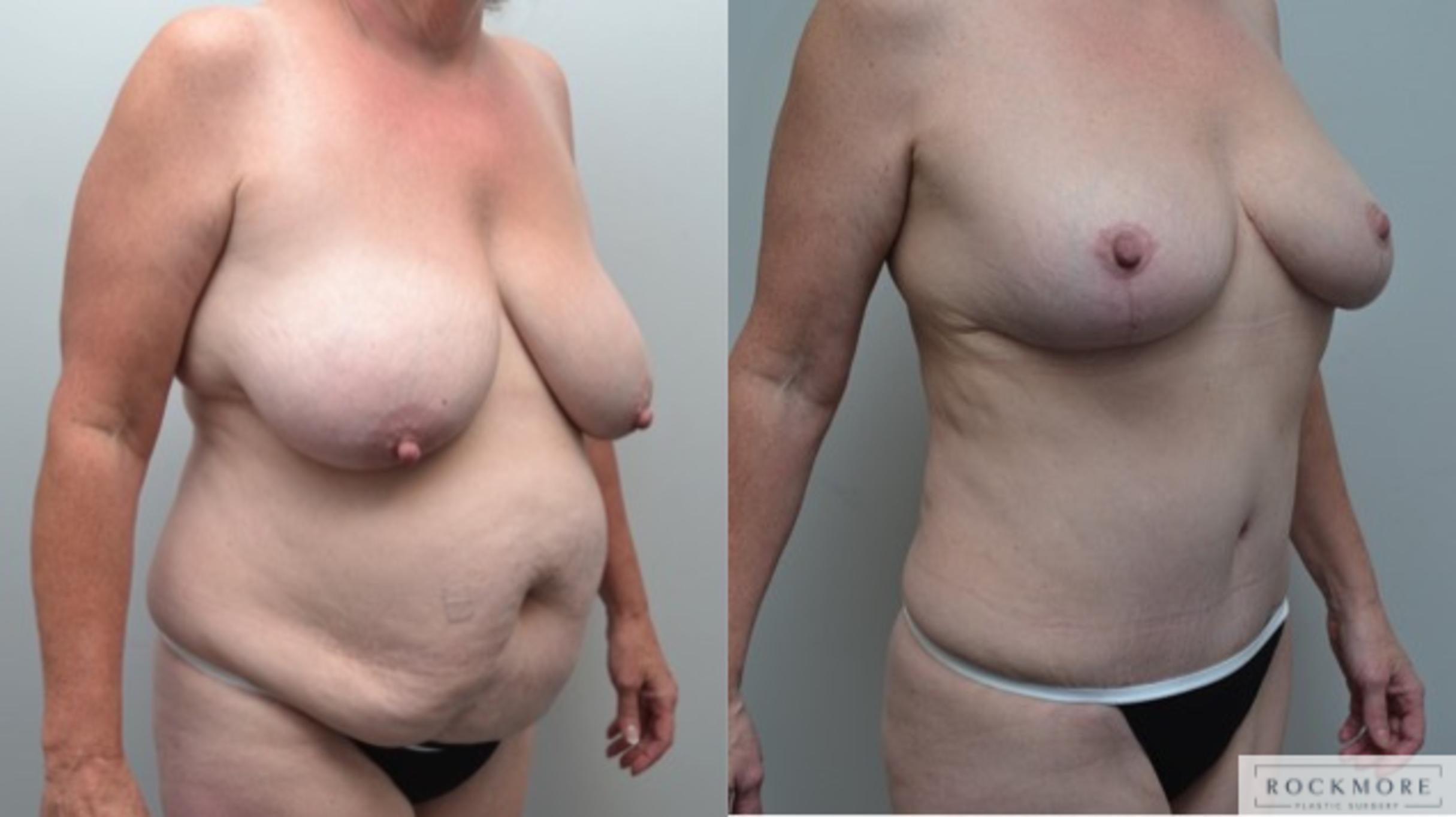 Before & After Breast Lift Case 273 View #4 View in Albany & Latham, New York