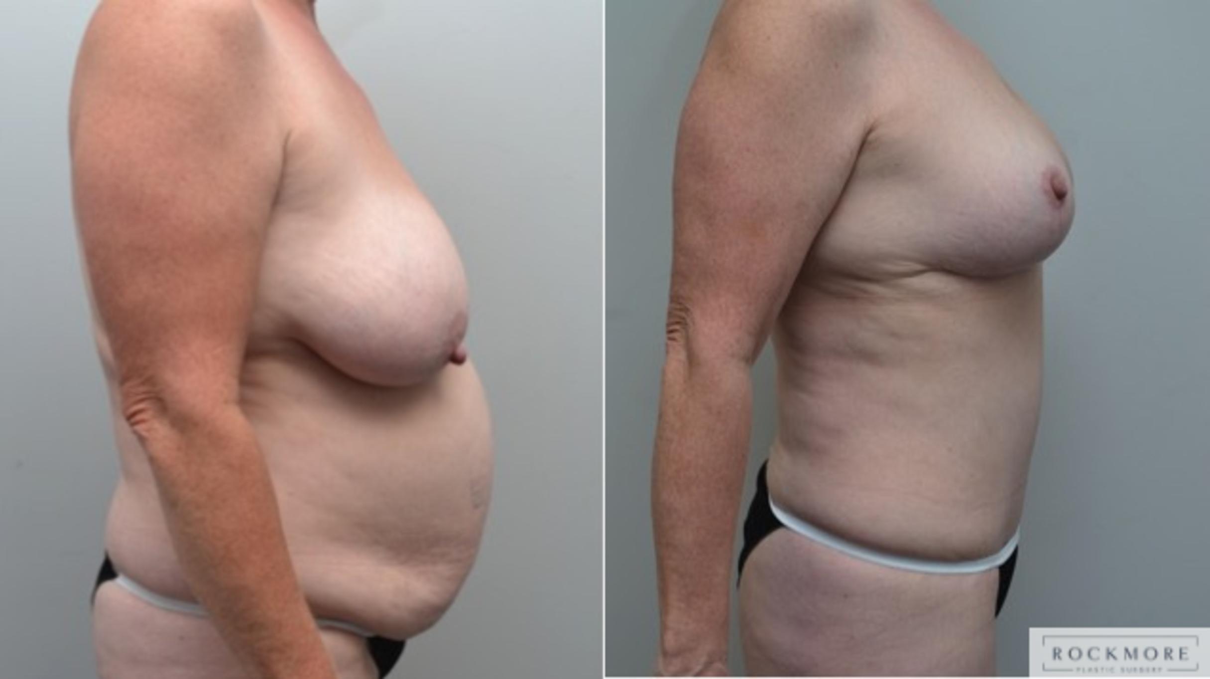 Before & After Breast Lift Case 273 View #5 View in Albany & Latham, New York