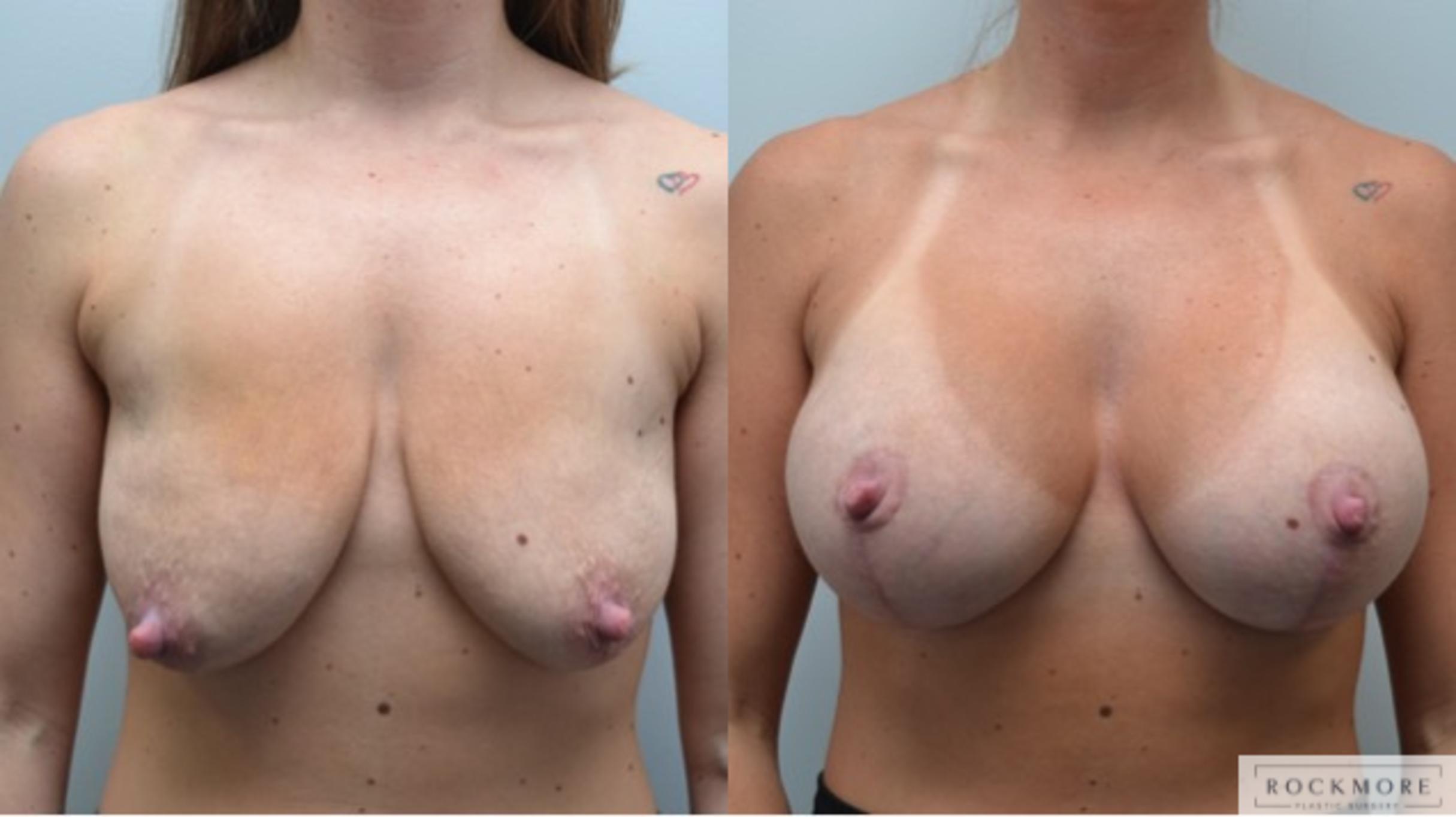 Before & After Breast Lift Case 287 View #1 View in Albany & Latham, New York