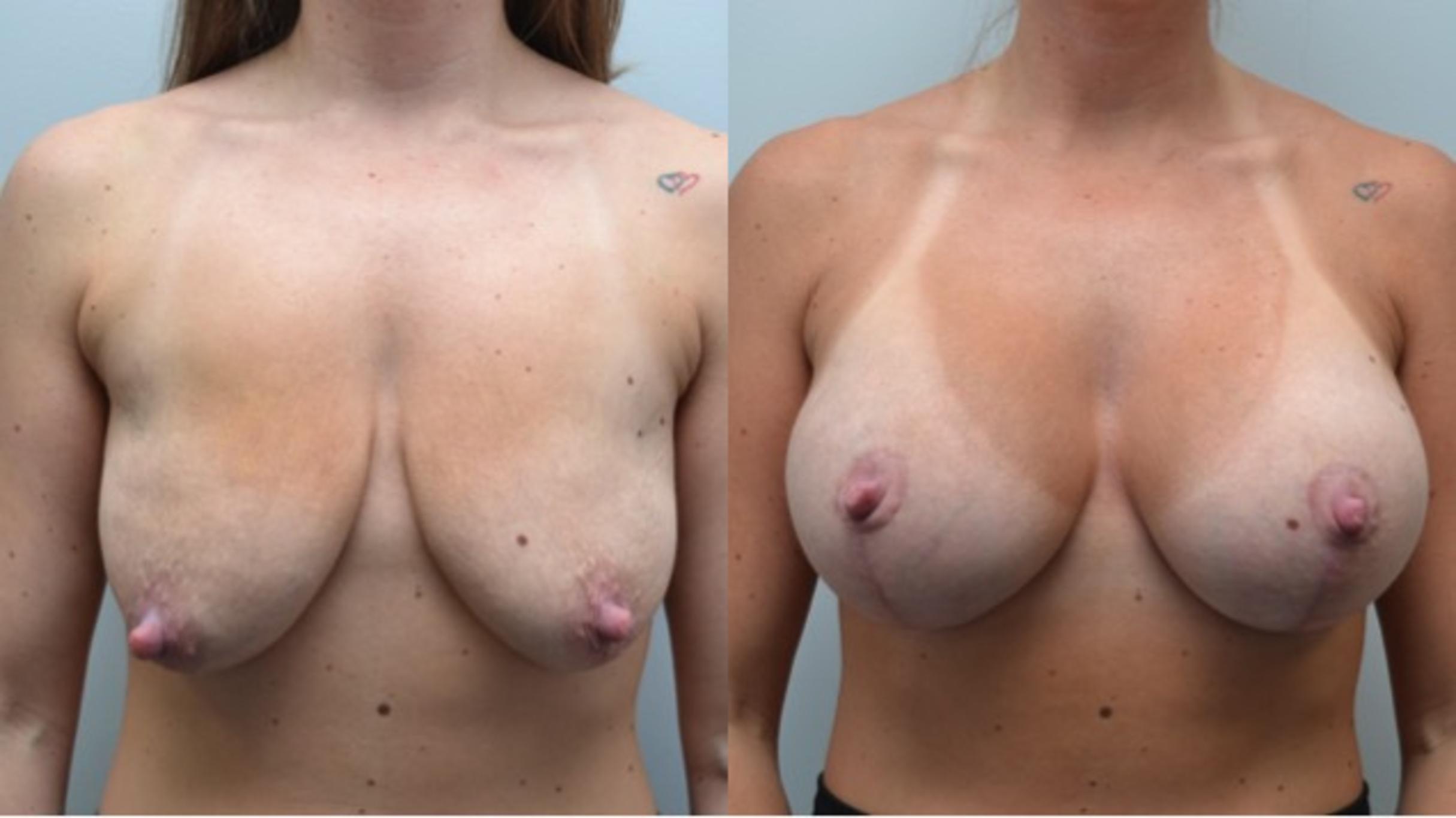 Before & After Breast Lift Case 287 View #1 View in Albany, Latham & Saratoga, New York