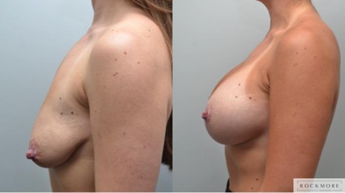 Before & After Breast Lift Case 287 View #2 View in Albany & Latham, New York