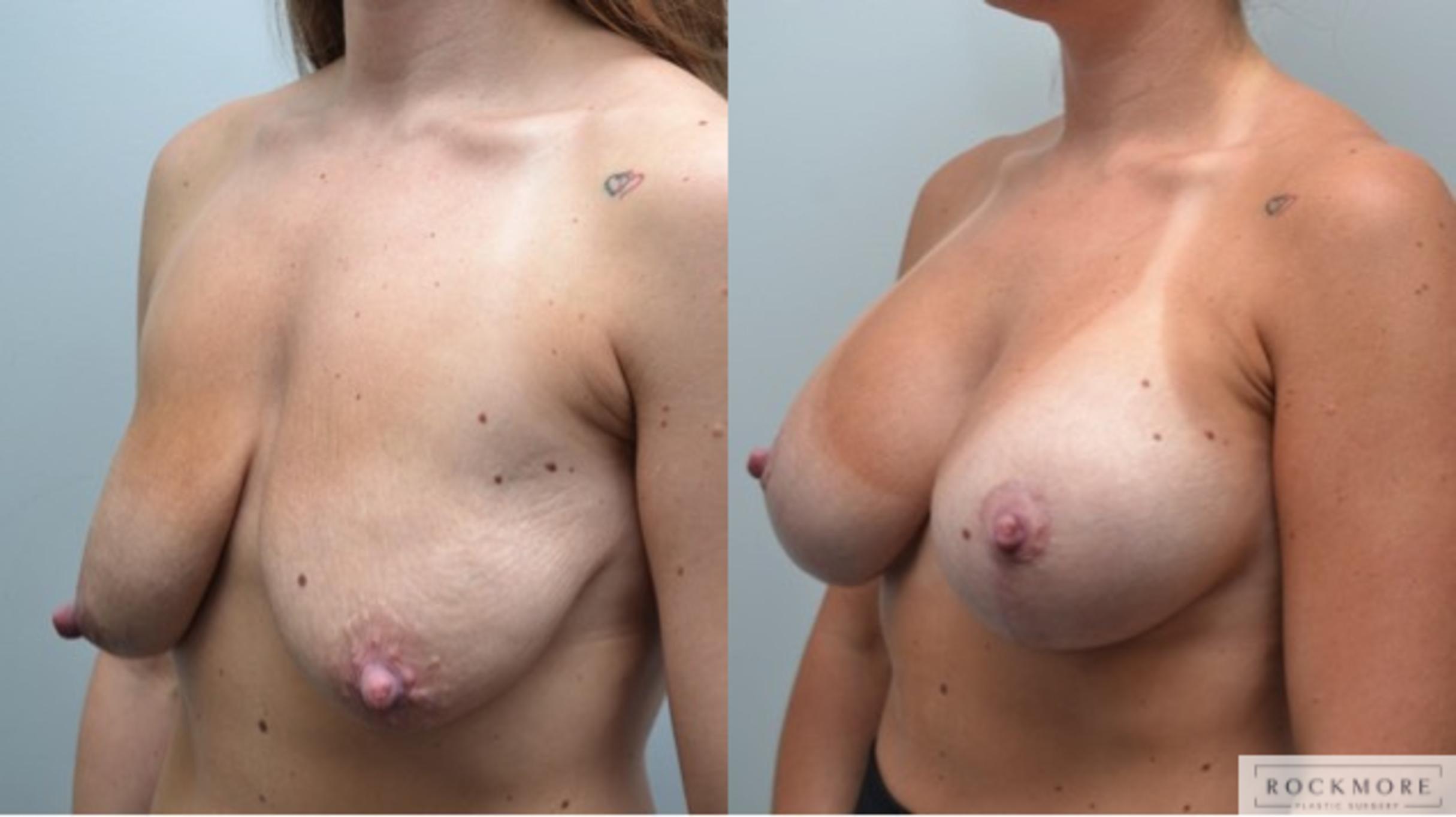 Before & After Breast Lift Case 287 View #3 View in Albany & Latham, New York