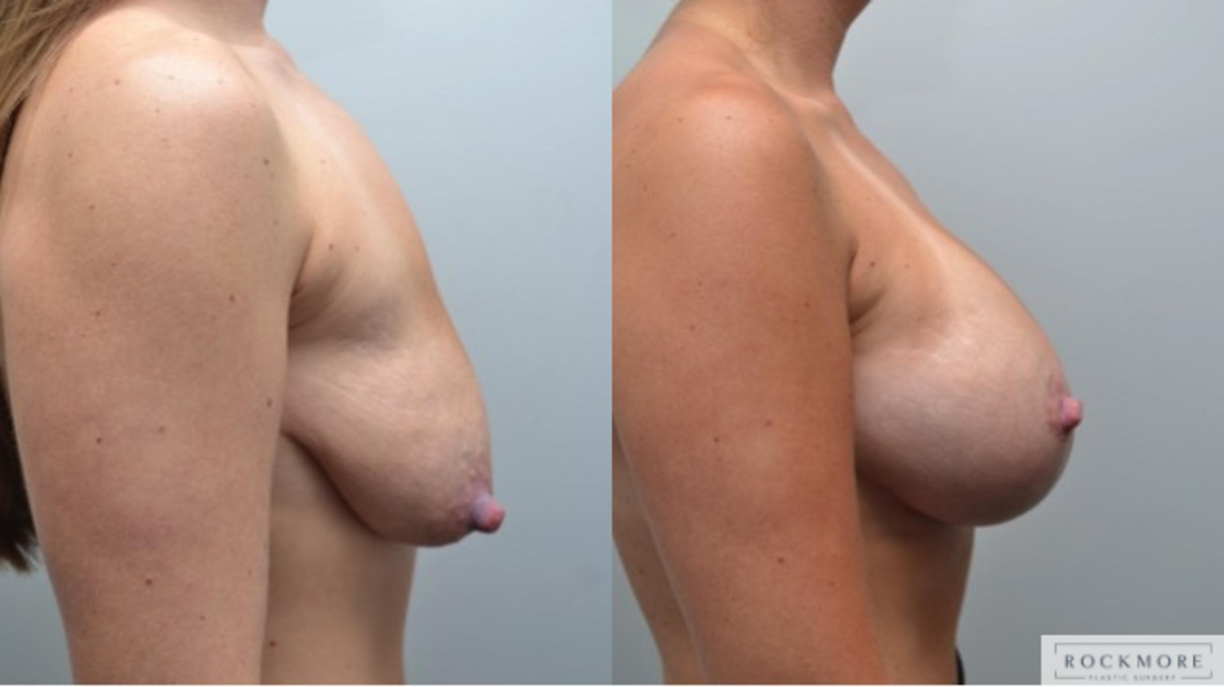 Before & After Breast Lift Case 287 View #4 View in Albany & Latham, New York
