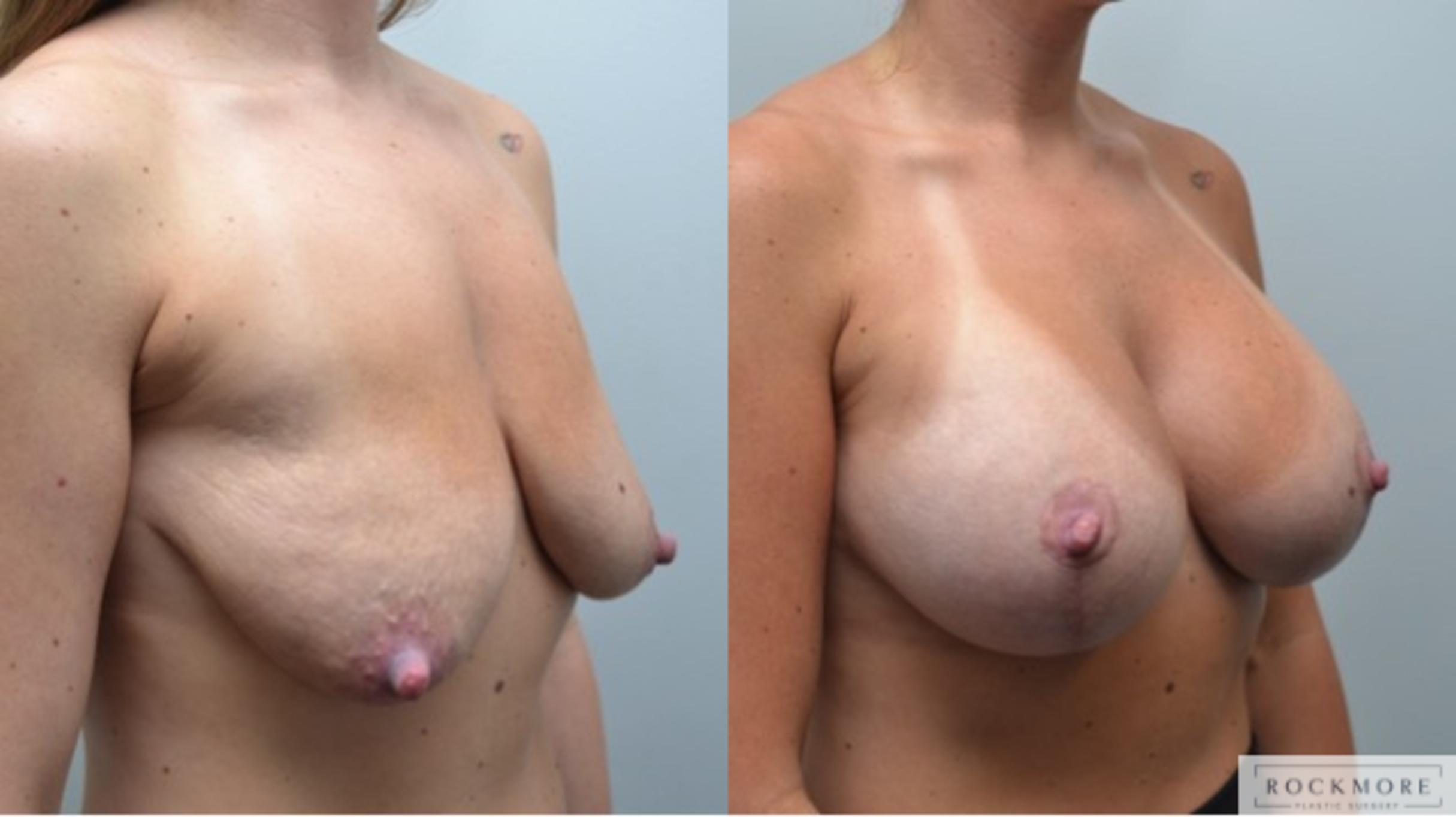 Before & After Breast Lift Case 287 View #5 View in Albany & Latham, New York