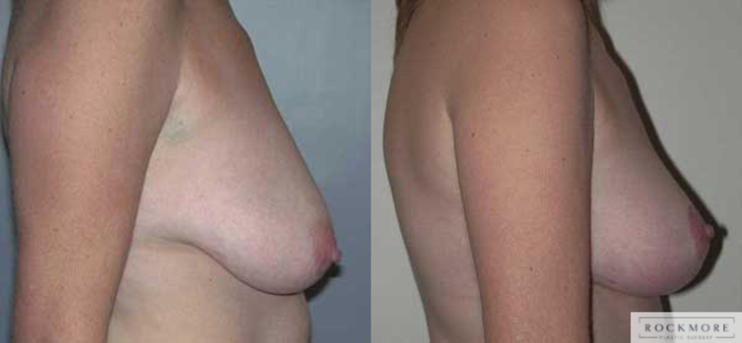 Before & After Breast Lift Case 3 View #2 View in Albany & Latham, New York