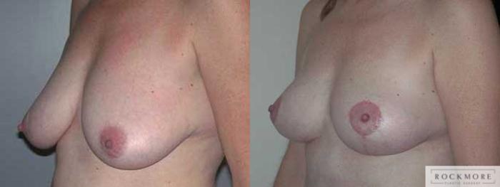 Before & After Breast Lift Case 3 View #3 View in Albany & Latham, New York