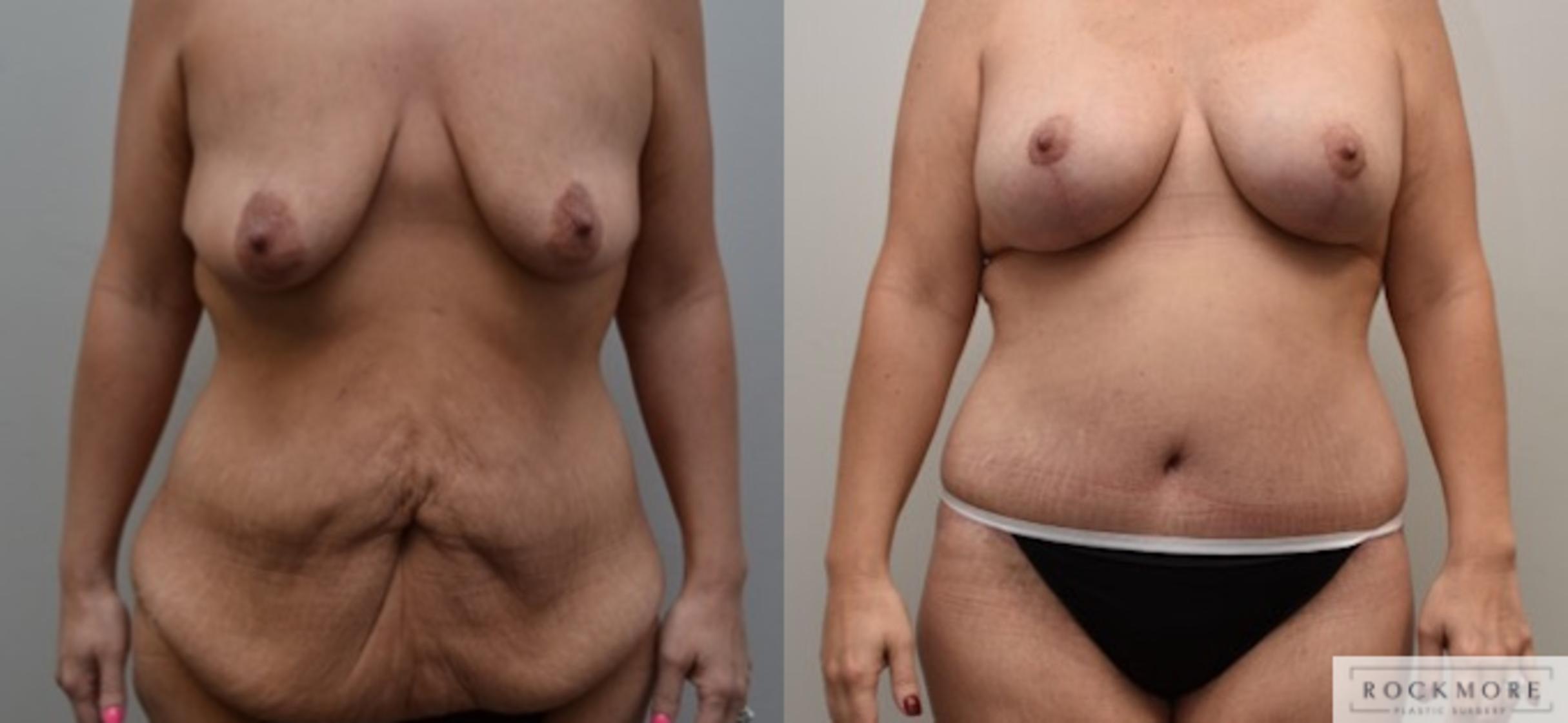 Before & After Breast Lift Case 309 View #1 View in Albany & Latham, New York