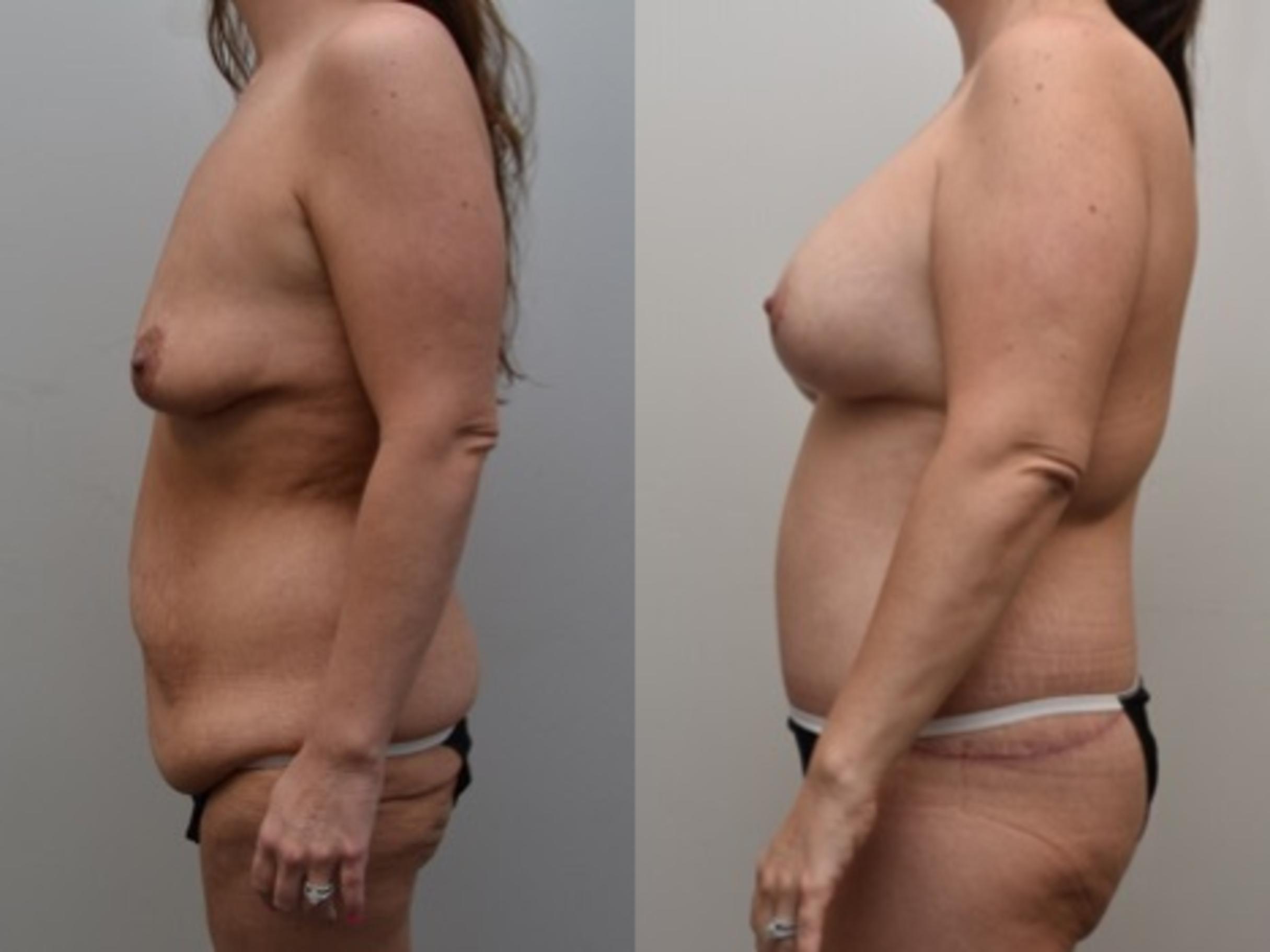 Before & After Breast Lift Case 309 View #2 View in Albany, Latham & Saratoga, New York