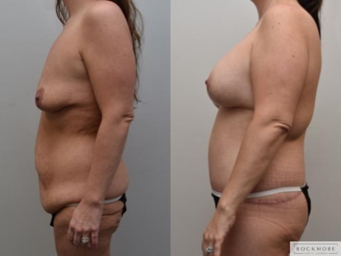Before & After Breast Lift Case 309 View #2 View in Albany & Latham, New York