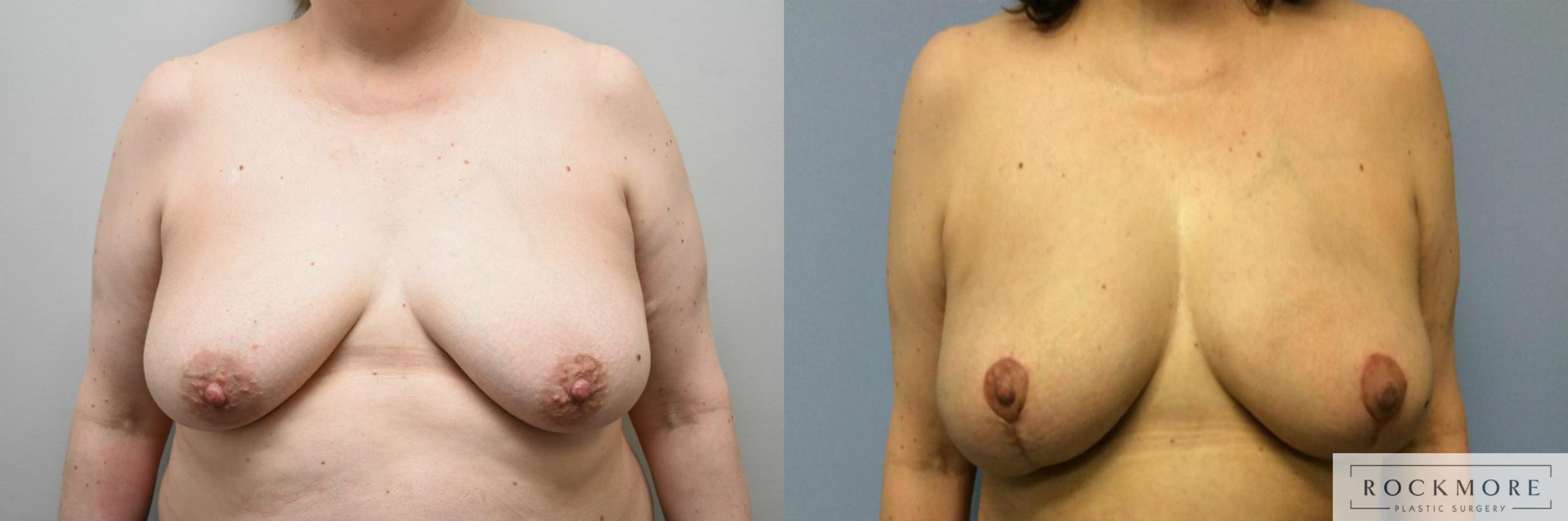 Before & After Breast Lift Case 313 View #1 View in Albany & Latham, New York