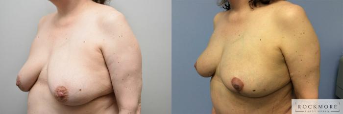 Before & After Breast Lift Case 313 View #2 View in Albany & Latham, New York