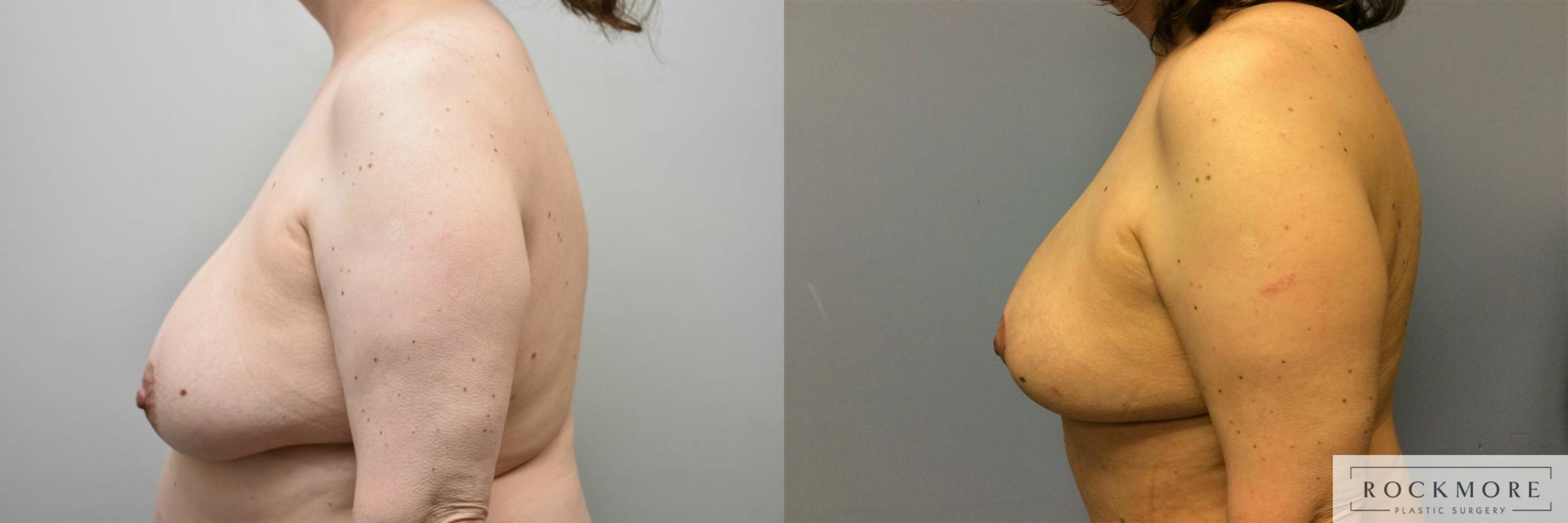 Before & After Breast Lift Case 313 View #3 View in Albany & Latham, New York