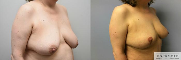 Before & After Breast Lift Case 313 View #4 View in Albany & Latham, New York