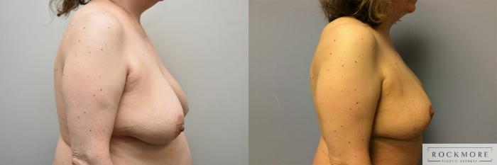 Before & After Breast Lift Case 313 View #5 View in Albany & Latham, New York