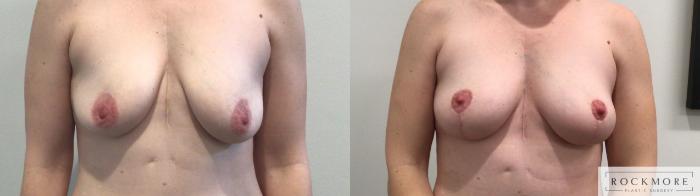 Before & After Breast Lift Case 433 Front View in Albany & Latham, New York