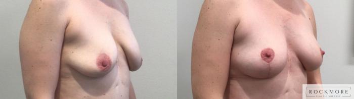 Before & After Breast Lift Case 433 Right Oblique View in Albany & Latham, New York