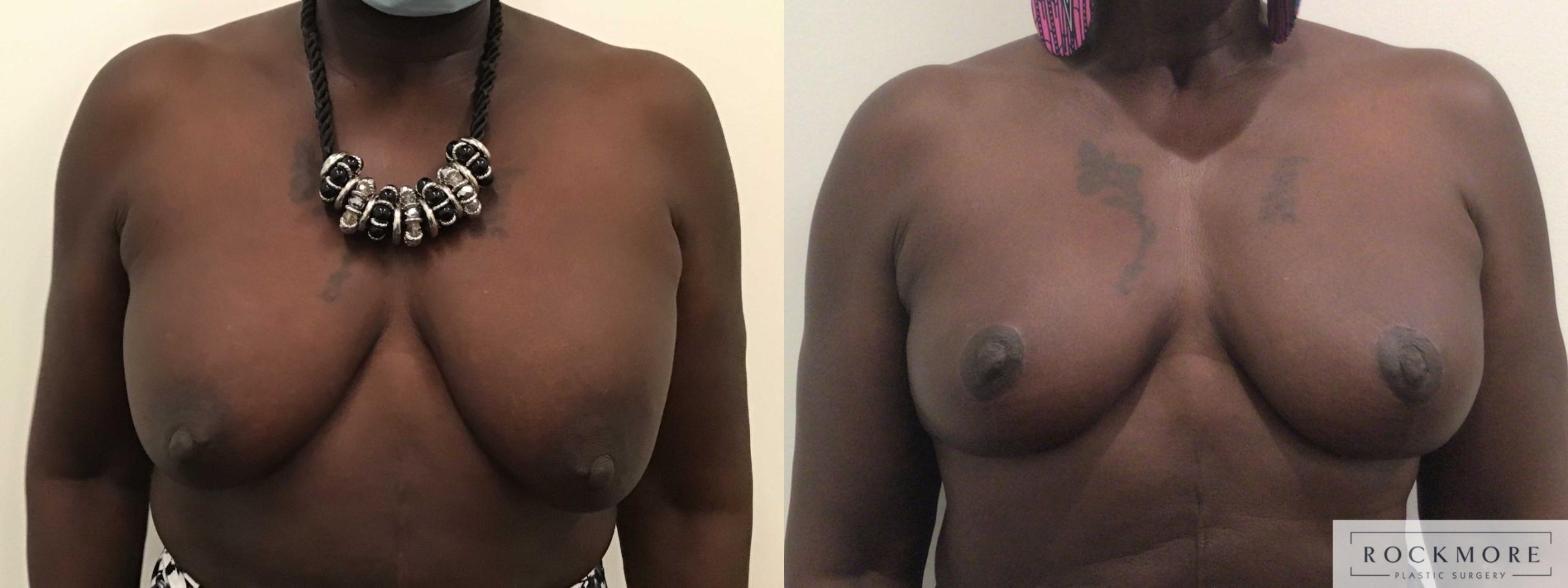 Before & After Breast Lift Case 454 Front View in Albany & Latham, New York