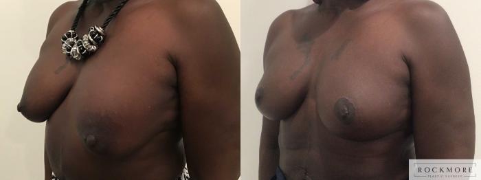 Before & After Breast Lift Case 454 Left Side View in Albany & Latham, New York