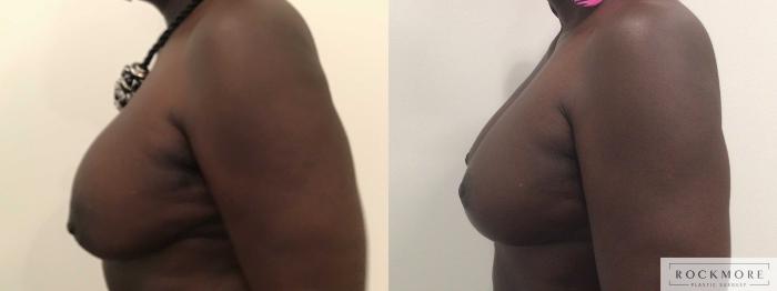 Before & After Breast Lift Case 454 Right Side View in Albany & Latham, New York