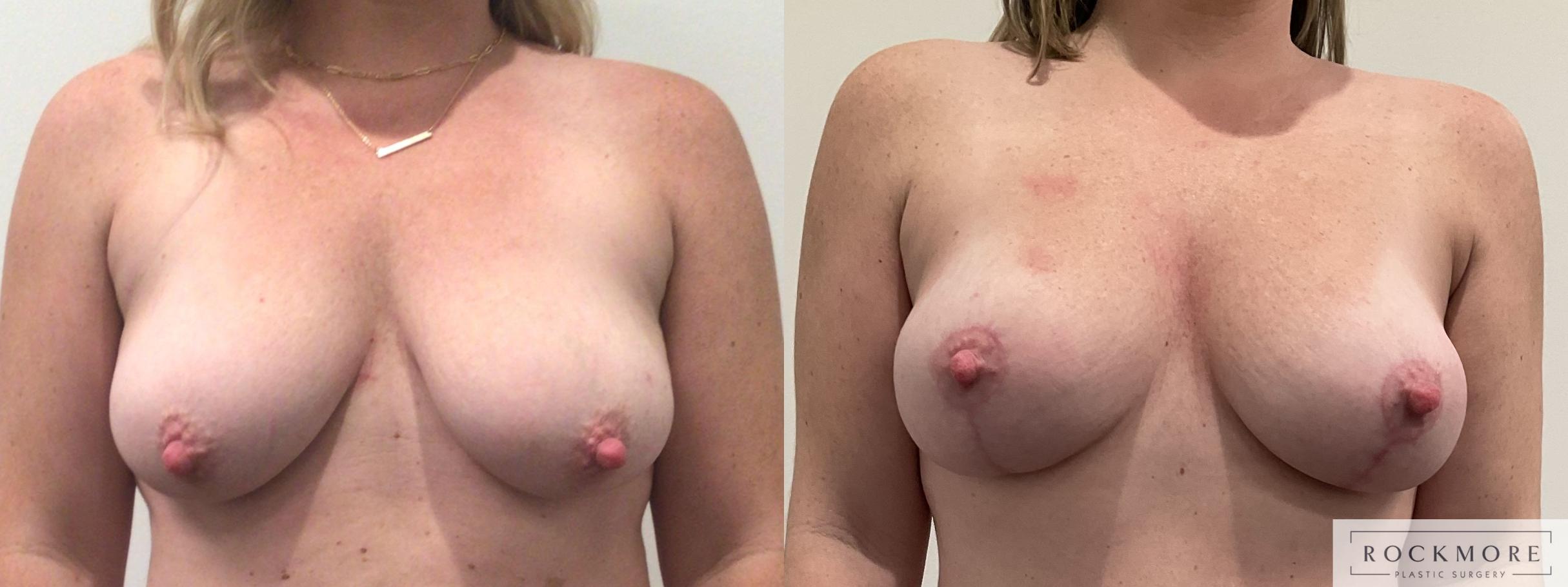 Before & After Breast Lift Case 460 Front View in Albany & Latham, New York