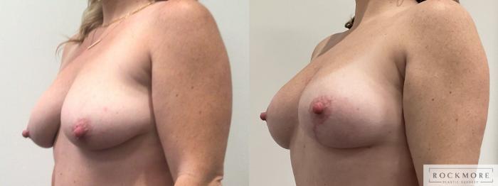 Before & After Breast Lift Case 460 Left Side View in Albany & Latham, New York