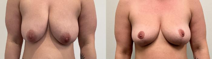 Before & After Breast Lift Case 499 Front View in Albany, Latham & Saratoga, New York